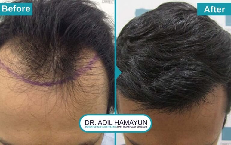 Best Hair Transplant in Peshawar