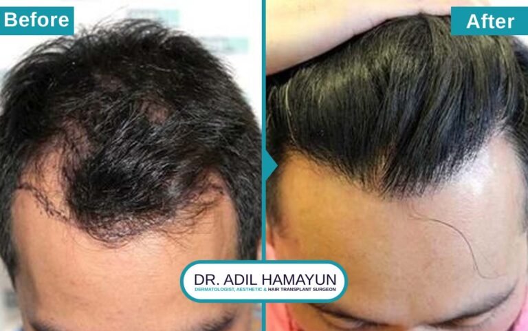 Best Hair Transplant in Peshawar