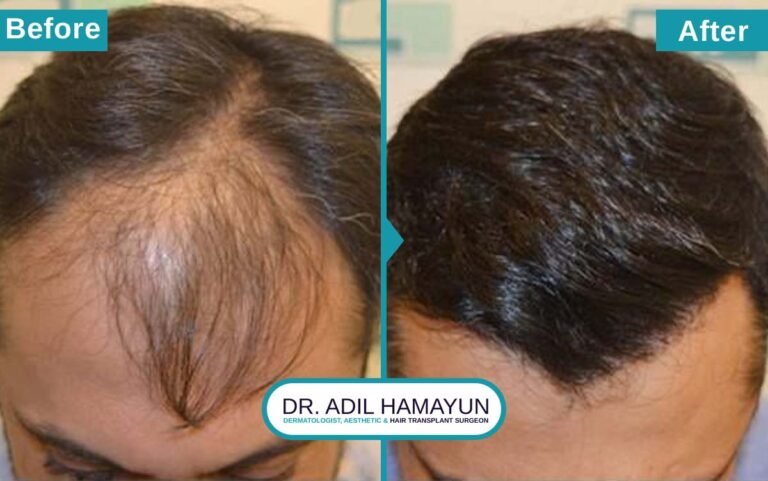 Best Hair Transplant in Peshawar