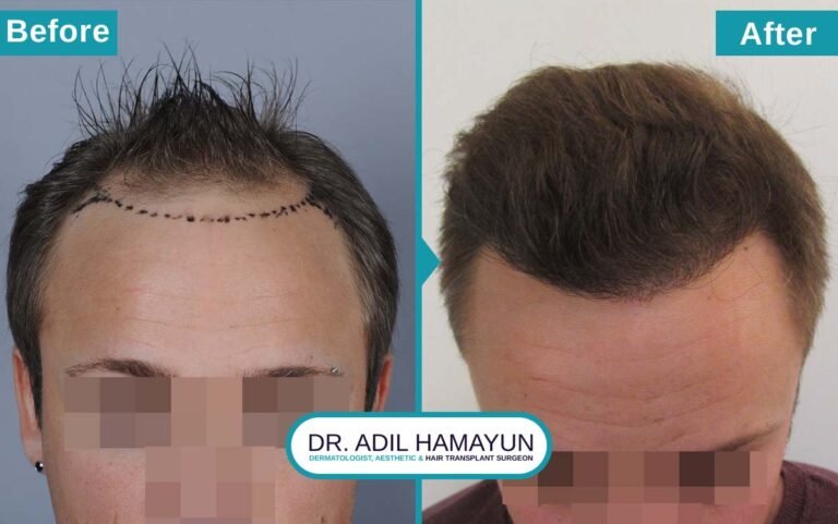 Best Hair Transplant in Peshawar