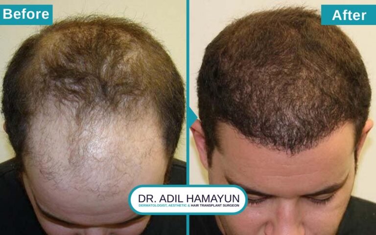Best Hair Transplant in Peshawar