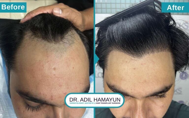Best Hair Transplant in Peshawar